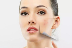 Pigmentation Treatment